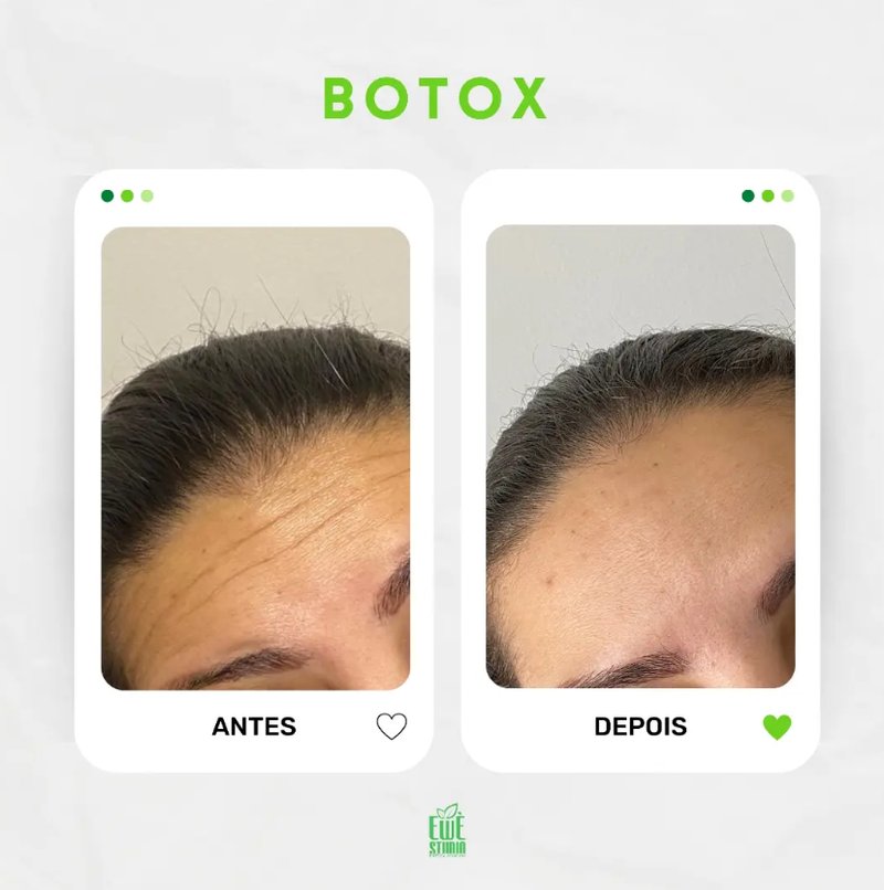 Antes e depois de Botox na Ewè Estética Avançada