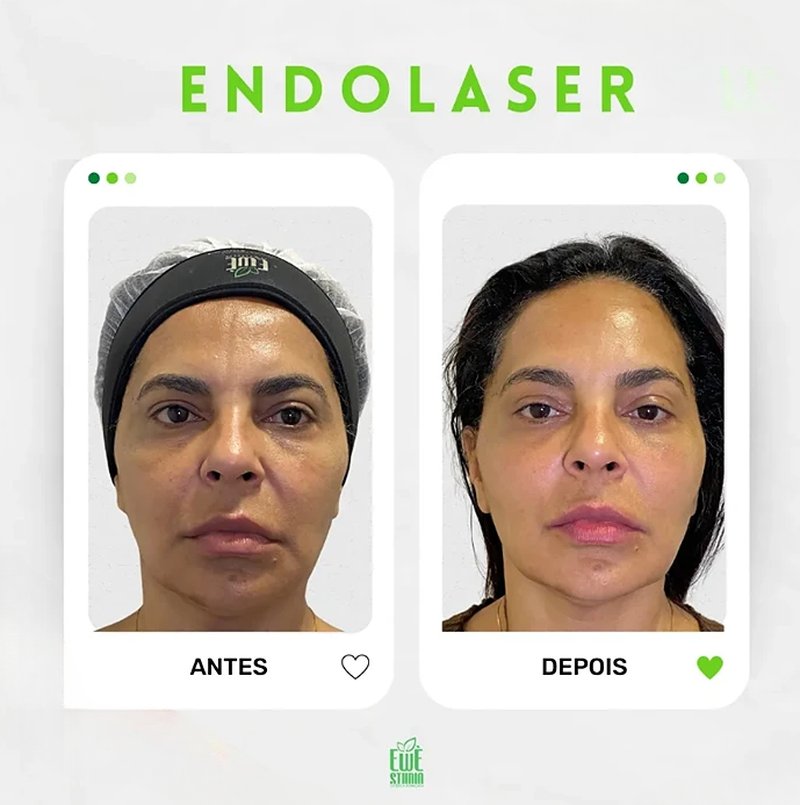 Antes e depois de Endolaser na Ewè Estética Avançada