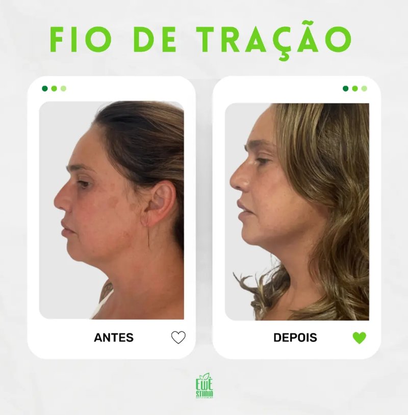 Antes e depois de Fio de Tração na Ewè Estética Avançada