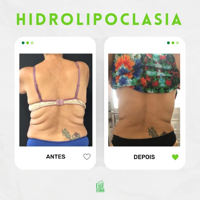 Antes e depois de Hidrolipoclasia na Ewè Estética Avançada